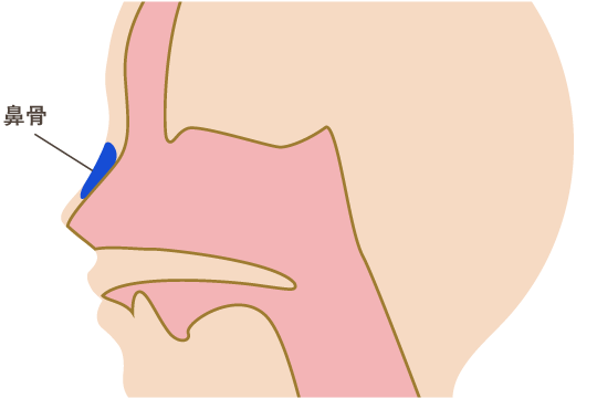 鼻骨骨折・顔面骨骨折